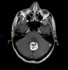 http://www.dizziness-and-balance.com/disorders/central/cerebellar/images/axial-t1-post-hemangiob-sma.jpg