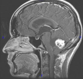 http://www.dizziness-and-balance.com/disorders/central/cerebellar/images/saggital-t1-small-post.jpg