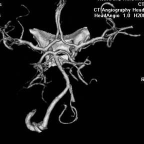 http://www.dizziness-and-balance.com/disorders/central/images/vascular/CT%20angiogram2.jpg