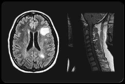 Cervello MRI e scansioni del midollo spinale dei pazienti con sclerosi multipla.