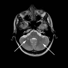 http://www.dizziness-and-balance.com/disorders/central/images/MS/ms%20cerebellum-annotated.jpg