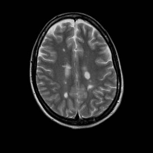 http://www.dizziness-and-balance.com/disorders/central/images/MS/ms%20cortex-above-ventricles.jpg