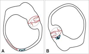 Flessione della cupola a causa di uno flusso endolinfatico indotta da una resistenza idrodinamica delle particelle (A: Canalolithiasis) o un effetto gravitazionale diretta dei detriti otolitica (B: cupulolithiasis).