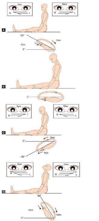 Vertigine parossistica posizionale benigna e posizionale Vertigo Varianti 