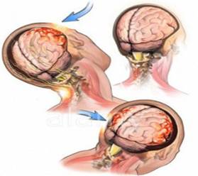 B98E4P Coup-Contracoup Brain Injury