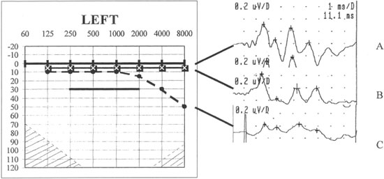 http://www.tinnitusjournal.com/imagebank/images/v9n2a06-fig01.jpg