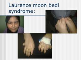 Risultati immagini per sindrome di Laurence-Moon-Biedl