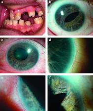 Axenfeld syndrome.jpg