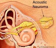 acoustic neuroma