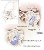 Schema di normale orecchio interno e allargata acquedotto vestibolare, mostrando la coclea, sacco endolinfatico, dotto endolinfatico, acquedotto vestibolare, allargata acquedotto vestibolare, e ampliato sacco endolinfatico.