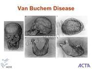 Risultati immagini per Van Buchem disease