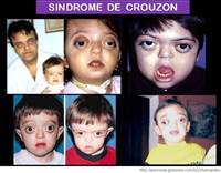 Risultati immagini per crouzon sindrome