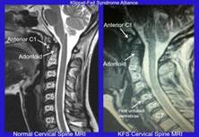 Cervical Spine KFS example