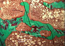 https://upload.wikimedia.org/wikipedia/commons/thumb/d/d4/Osteitis_Fibrosis_Cystica.jpg/220px-Osteitis_Fibrosis_Cystica.jpg