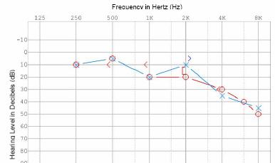 http://www.dizziness-and-balance.com/disorders/unilat/images/VN%20case/audiogram.jpg