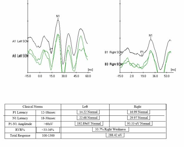 http://www.dizziness-and-balance.com/disorders/unilat/images/VN%20case/VEMP.jpg