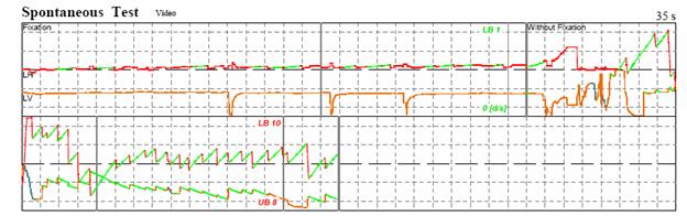 http://www.dizziness-and-balance.com/disorders/unilat/images/VN%20case/Spontaneous.jpg