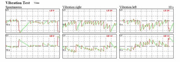 http://www.dizziness-and-balance.com/disorders/unilat/images/VN%20case/Vibration.jpg