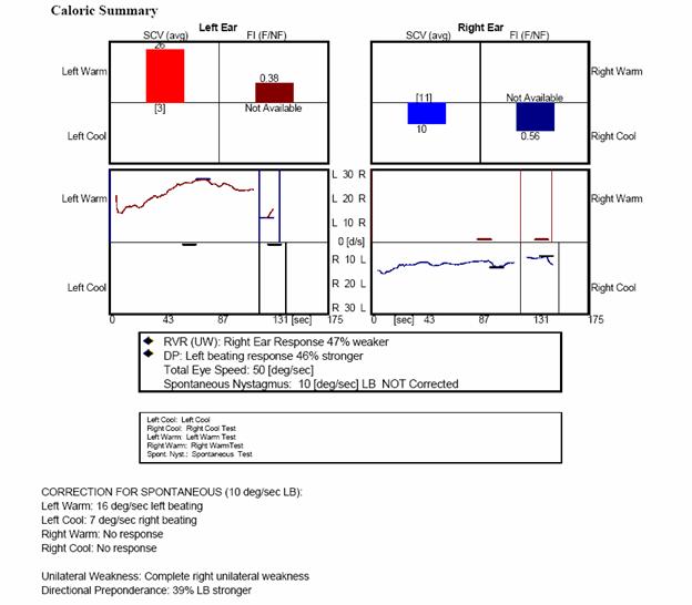 http://www.dizziness-and-balance.com/disorders/unilat/images/VN%20case/Caloric.jpg