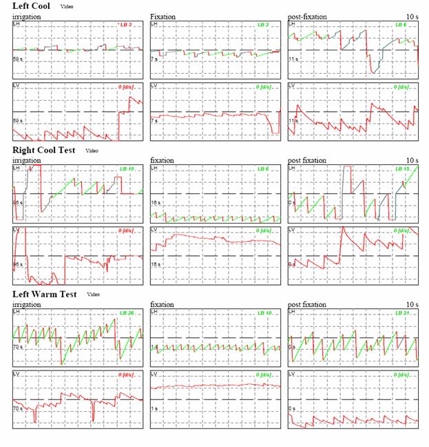 http://www.dizziness-and-balance.com/disorders/unilat/images/VN%20case/Caloric%20trace%201.jpg