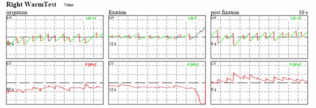 http://www.dizziness-and-balance.com/disorders/unilat/images/VN%20case/right%20warm.jpg