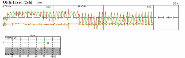 http://www.dizziness-and-balance.com/disorders/unilat/images/VN%20case/OKN.jpg