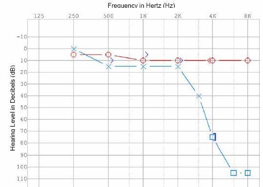 http://www.dizziness-and-balance.com/disorders/unilat/images/audio%20labyrinthitis.jpg