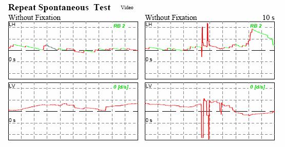 http://www.dizziness-and-balance.com/disorders/unilat/images/spontaneous%20labyrintitis.jpg