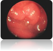 Adenoids seen through a nasal endoscope