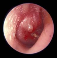 Severe Acute Otite media