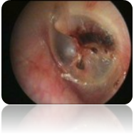 perforazione-traumatica-2.jpg