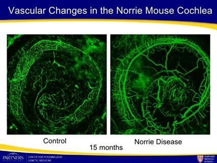 http://image.slidesharecdn.com/rehmphenotype-090909160500-phpapp02/95/understanding-and-expanding-the-phenotype-in-norrie-disease-17-728.jpg?cb=1252961124