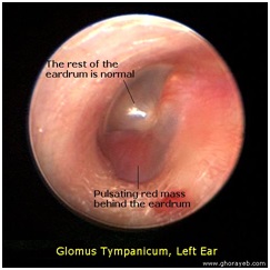 Tumori Glomici O Paraganglioma Timpanogiuguiare O Chemodectoma