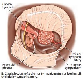 Tumori Glomici O Paraganglioma Timpanogiuguiare O Chemodectoma