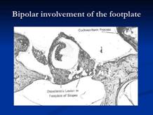 Bipolar involvement of the footplate 