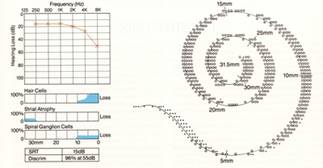 EARLY SENSORY PRESBYCUSIS