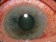 http://upload.wikimedia.org/wikipedia/commons/thumb/1/13/Acute_Angle_Closure-glaucoma.jpg/220px-Acute_Angle_Closure-glaucoma.jpg