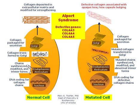 http://disorders.eyes.arizona.edu/sites/disorders.eyes.arizona.edu/files/disorder_images/alport%20syndrome.jpg