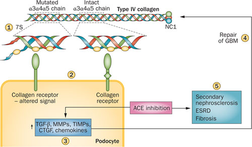 Alport syndrome|[mdash]|insights from basic and clinical research