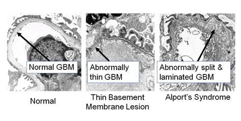 http://www.unckidneycenter.org/images/alport_gbm.gif