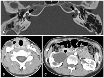 http://synapse.koreamed.org/ArticleImage/0038KJORL-HN/kjorl-hns-54-784-g004-l.jpg