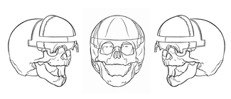 http://upload.wikimedia.org/wikipedia/commons/thumb/7/71/Bone_segments_removed_in_fronto-supraorbital_advancement.png/325px-Bone_segments_removed_in_fronto-supraorbital_advancement.png