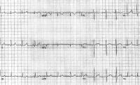 La sindrome geneticamente confermata QT lungo (LQTS) con