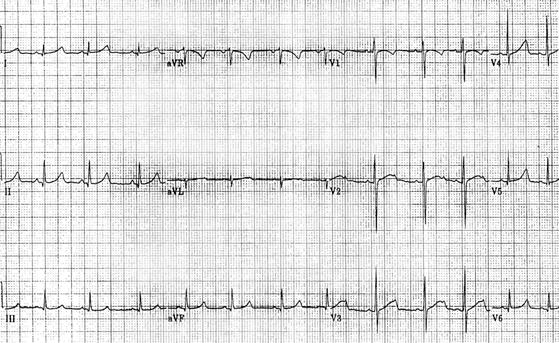 http://img.medscape.com/pi/emed/ckb/cardiology/150072-157826-1860.jpg