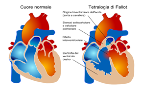 http://upload.wikimedia.org/wikipedia/commons/thumb/b/b1/Tetralogy_of_Fallot_it.svg/614px-Tetralogy_of_Fallot_it.svg.png