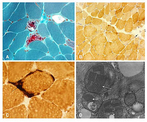 http://upload.wikimedia.org/wikipedia/commons/thumb/4/44/Modified_Gomori_trichrome_stain_showing_several_ragged_red_fibers.jpg/300px-Modified_Gomori_trichrome_stain_showing_several_ragged_red_fibers.jpg