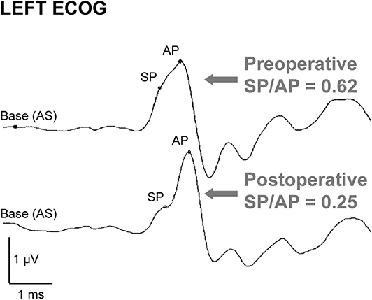 Vertigini da III finestra