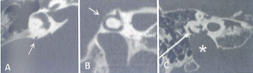 Figura 8. Una DCSP destra (freccia) a contatto con la fossa cranica posteriore vista in TC in proiezione assiale (A) e in una ricostruzione lungo il p