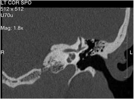 Figura 6 - la scansione CT coronale del temporale illustra con chiarezza l'osso mancante nella parte superiore della canale osseo semicircolare anteri