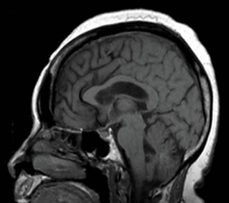 Risonanza magnetica del cervello in sezione sagittale